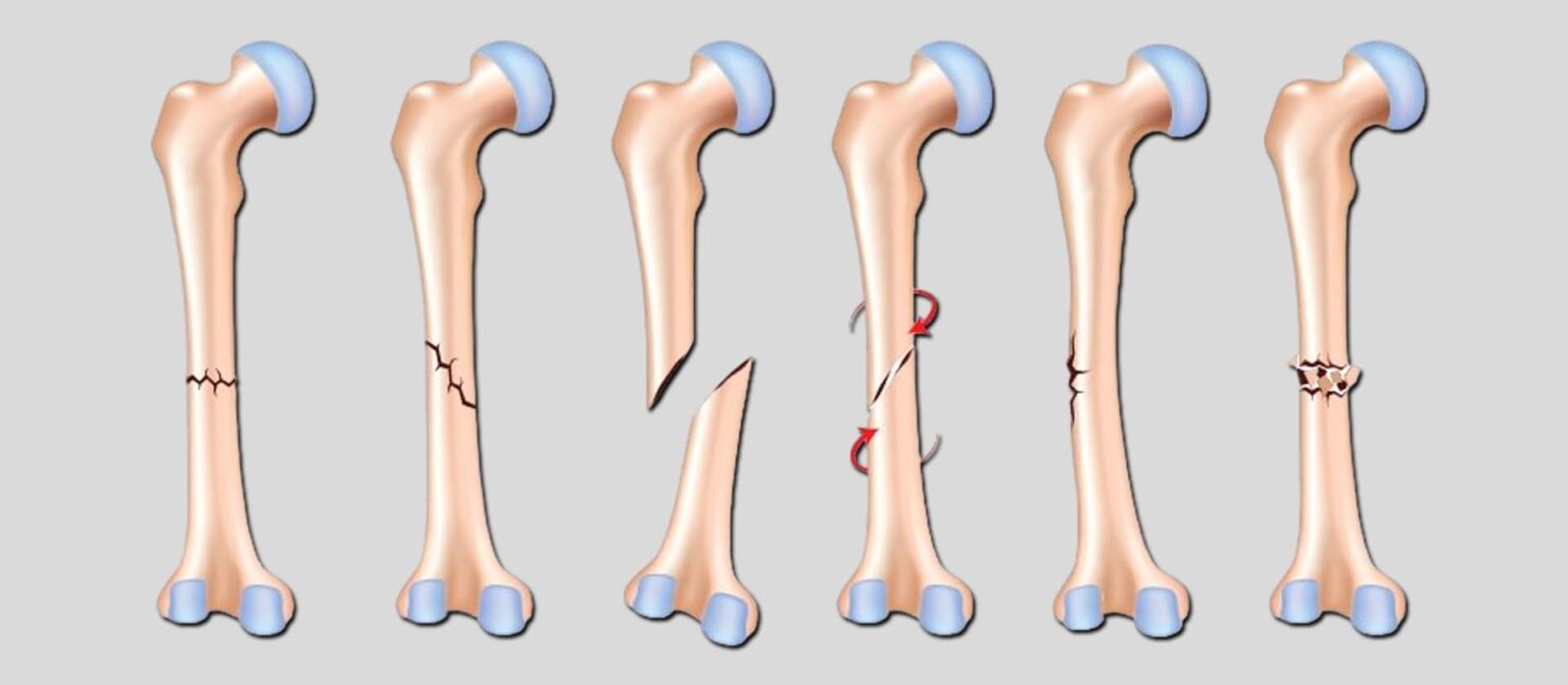 An Overview of the Most Common Causes of Fractures in the Bones - HEMC ...