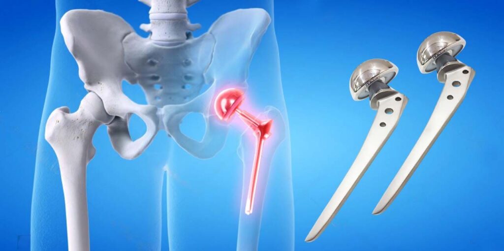 Hip Prosthesis: What are the Types, and Benefits? - HEMC Ortho