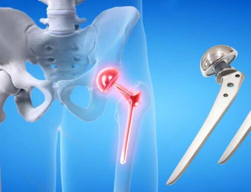 Hip Prosthesis:  What are the Types, and Benefits?