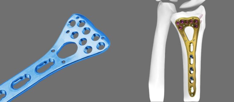 How does LCP Radius Fixed Angle Plate work, and what are its benefits