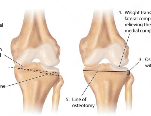 Osteotomy – A Comprehensive Guide to the Procedure