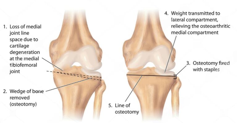 Osteotomy - A Comprehensive Guide to the Procedure