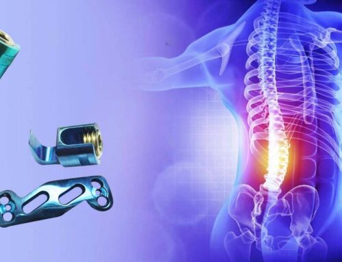 Spine Implants – It’s Types and Purpose in Health Care