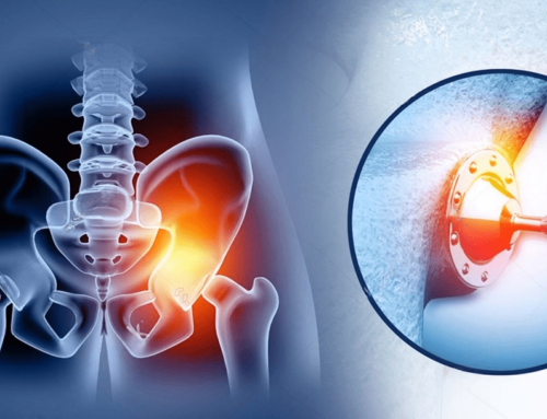 Total Hip Replacement: A Comprehensive Guide