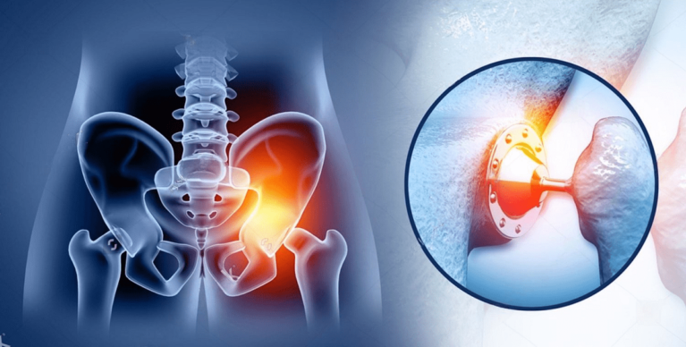 Total Hip Replacement - A Comprehensive Guide