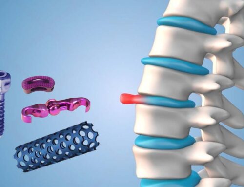 A Guide to Choosing the Right Spine Implants