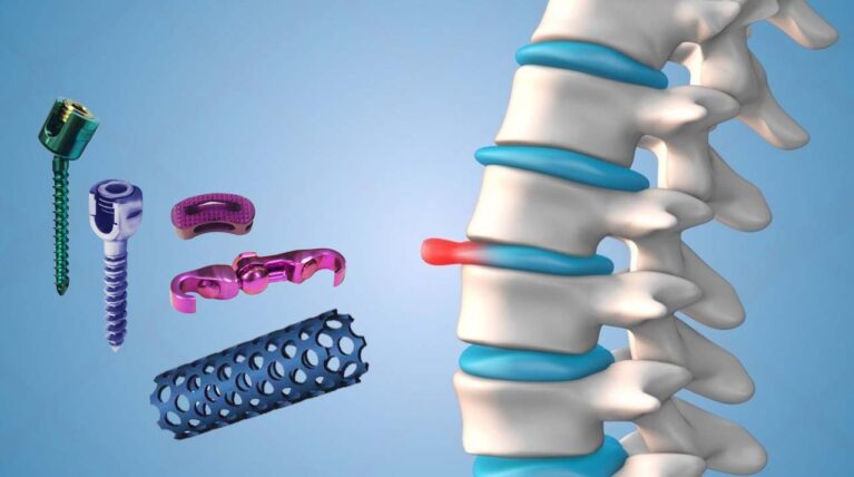 Spine Implants